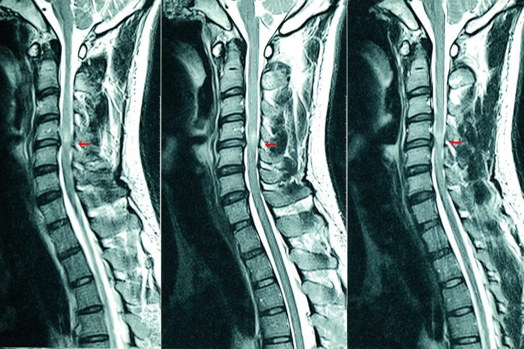 MRI films of personal injury to the spinal column. 